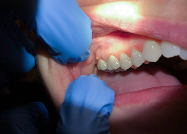 Best Emergency Tooth Extraction in Adairsville, GA