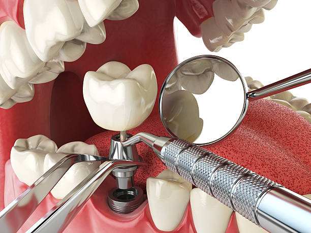 Best Emergency Tooth Extraction in Adairsville, GA